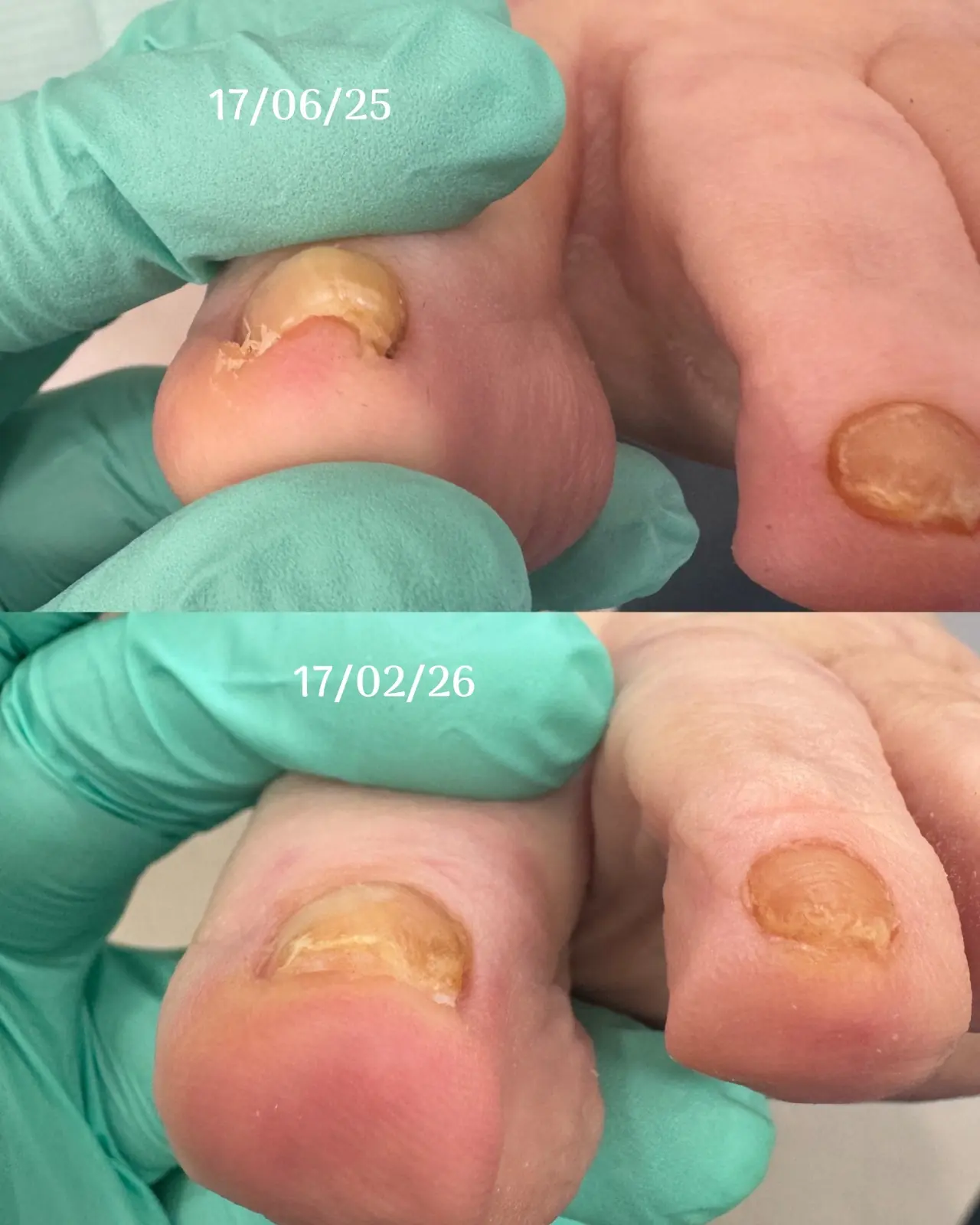 Evolución de una uña clavada tratada con ortonixia