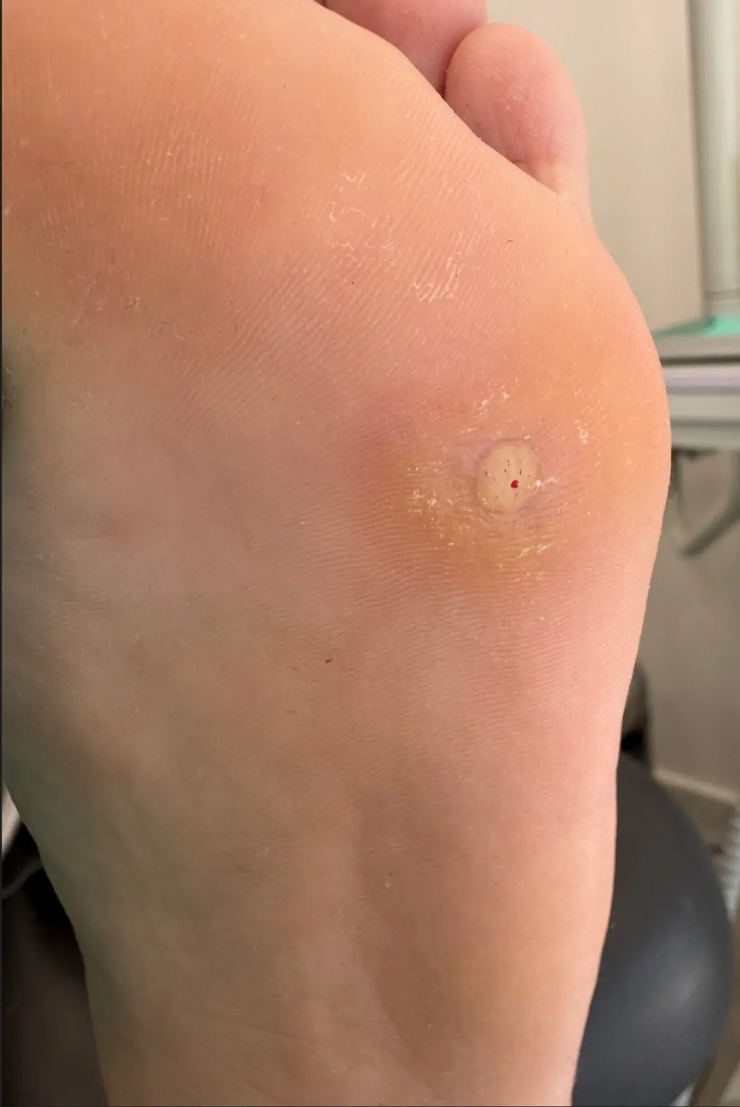 Papiloma plantar (verruga) en la planta del pie
